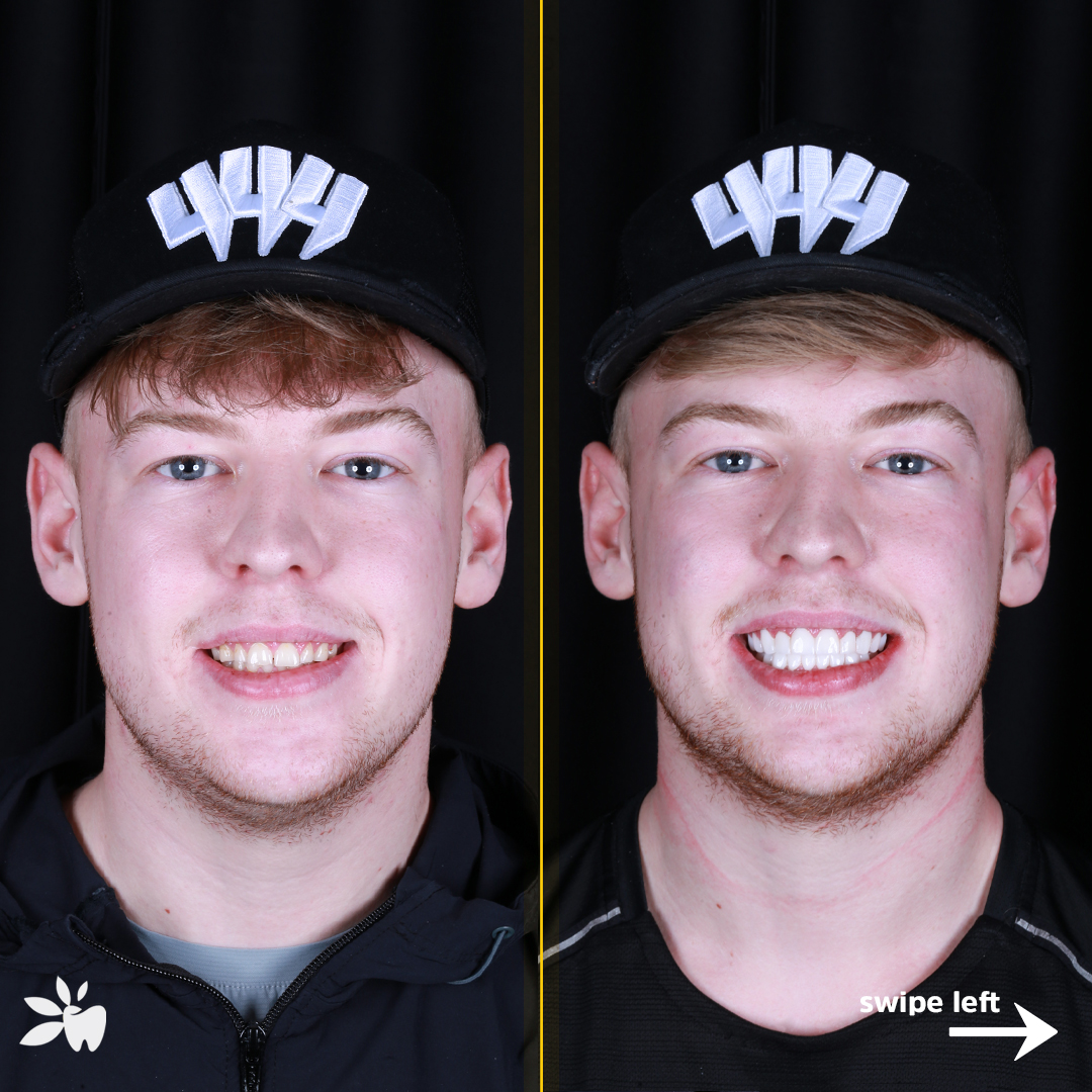 Ace-before-after-face
