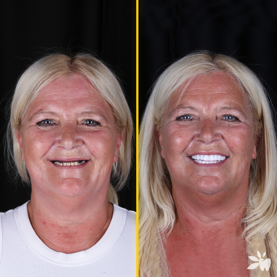Alison-before-after-face