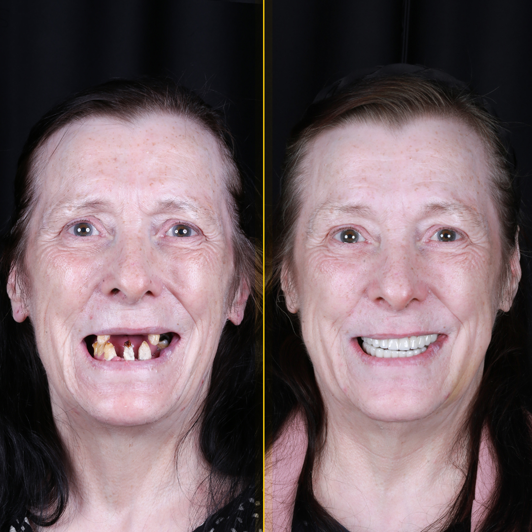 Anne-before-after-face