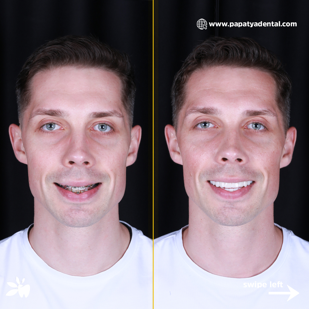 Borys-before-after-face