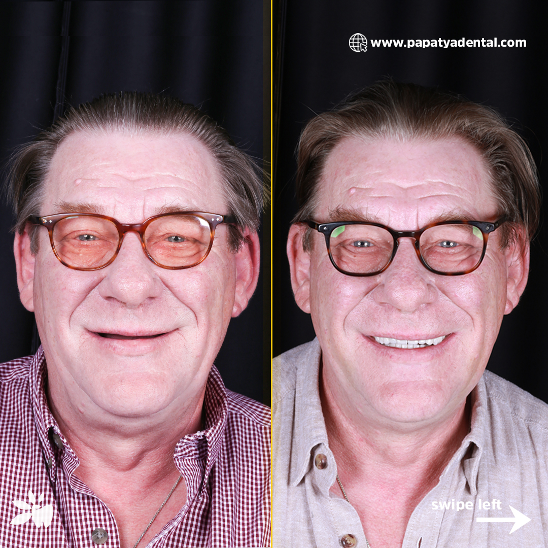 Hendrik-before-after-face