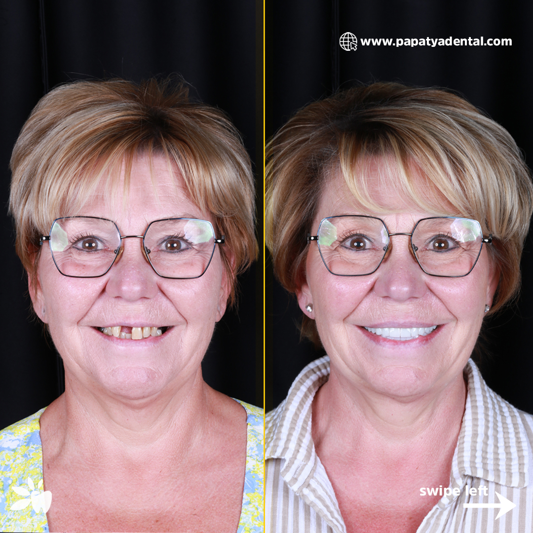 Ingrid-before-after-face-post