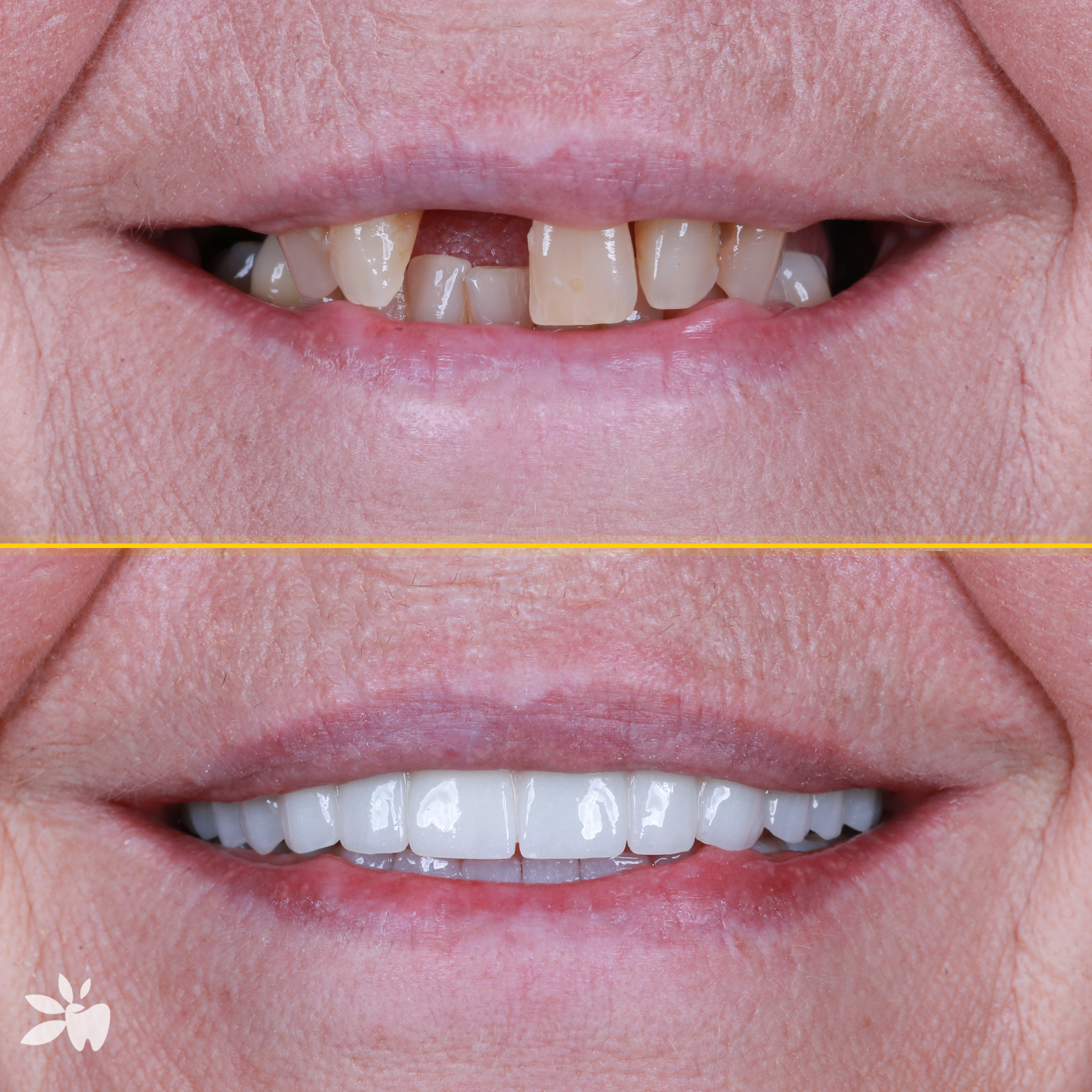 Ingrid-before-after-post
