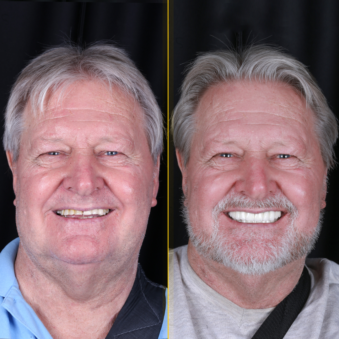 Robert-before-after-face